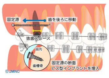矯正用アンカースクリューの使用
