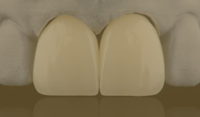 白い詰め物・被せ物治療について