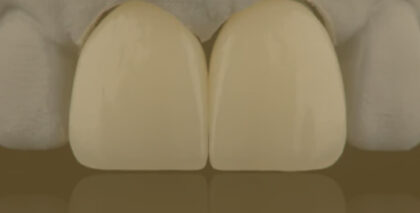 白い詰め物・被せ物治療について